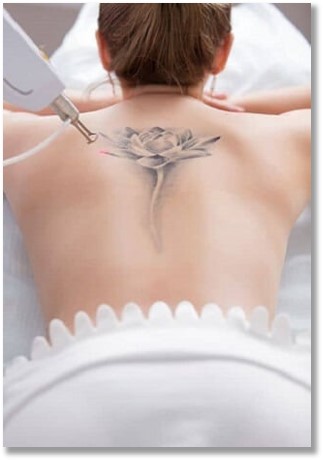 Eliminación de tatuajes con láser profesional, tratamiento seguro y eficaz para aclarar y eliminar pigmentos de la piel Eliminación de tatuajes con láser profesional, tratamiento seguro y eficaz para aclarar y eliminar pigmentos de la piel.